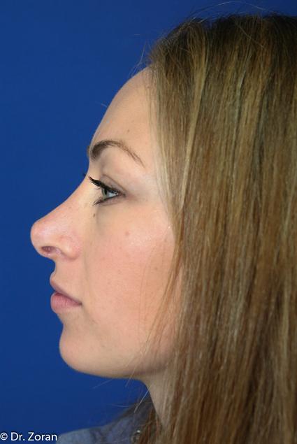 RHINOPLASTY - NOSE SURGERY 61