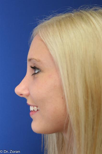RHINOPLASTY - NOSE SURGERY 62