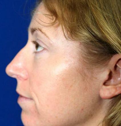 before facial fat grafts