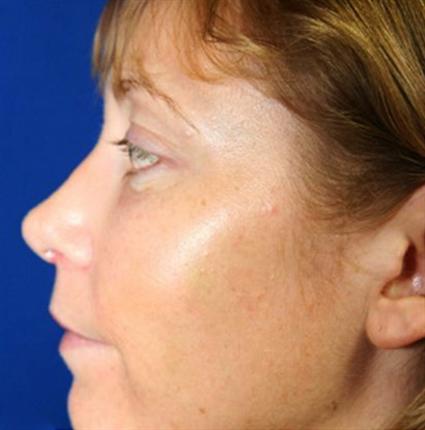 ACIAL, CHEEK IMPLANTS - FACIAL FAT GRAFTS - RHINOPLASTY - NOSE SURGERY REVISION 63