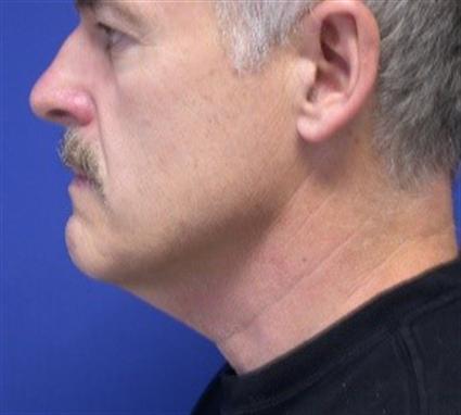 before-neck-lift
