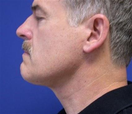 NECK LIFT - NECK LIPOSUCTION 65