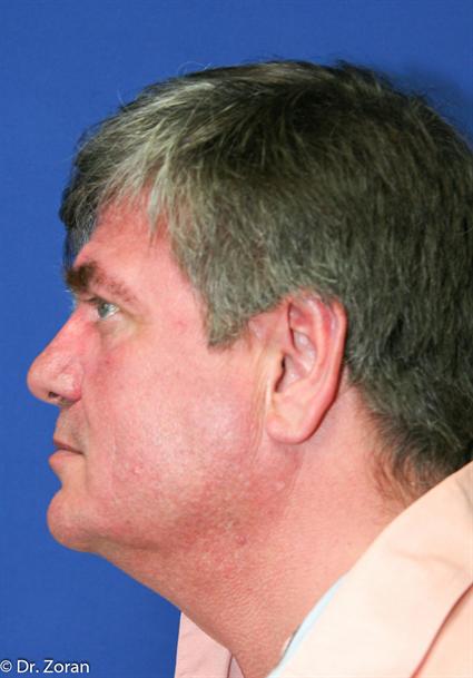 NECK LIPECTOMY 66