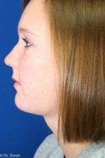 NECK LIPECTOMY - CHIN IMPLANT 67