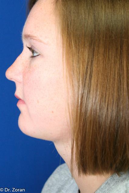 NECK LIPECTOMY - CHIN IMPLANT 67
