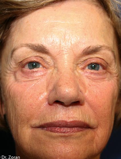 facial rejuvenation-before