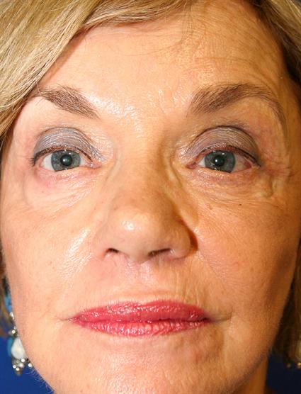 FACE AND NECK LIFT - UPPER AND LOWER EYELIDS - BROW LIFT 69