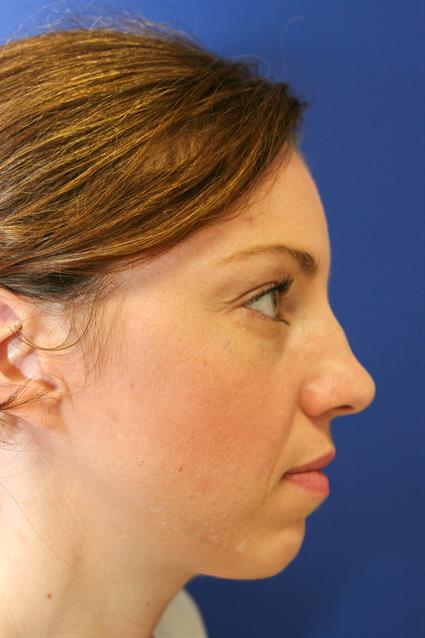 before facial chin implants
