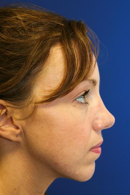 RHINOPLASTY AND CHIN IMPLANTS 4
