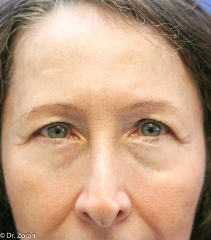 before-brow-lift