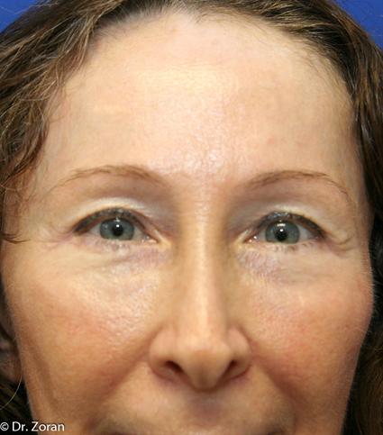 BROW LIFT CASE 71