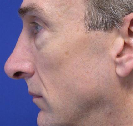 ETHNIC RHINOPLASTY