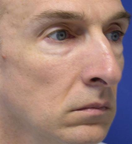 before male rhinoplasty