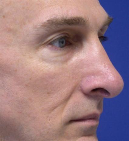 RHINOPLASTY - NOSE SURGERY 73
