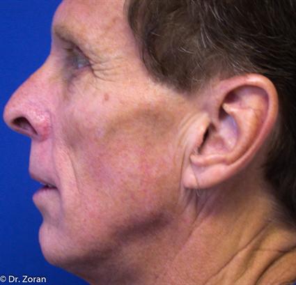 before male rhinoplasty