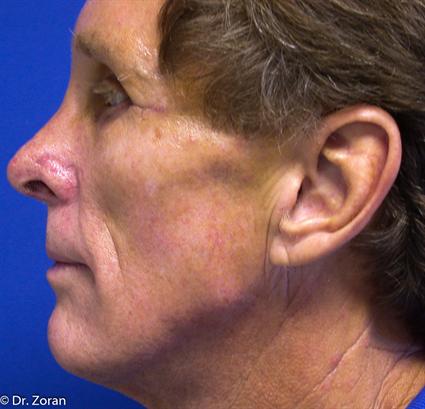 RHINOPLASTY - NOSE SURGERY 74