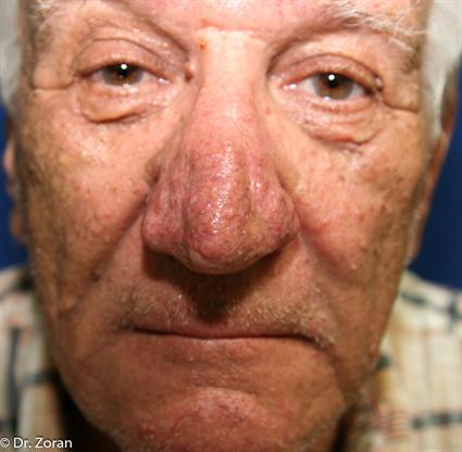 rhinophyma
