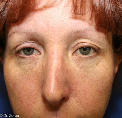 blepharoplasty-before