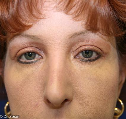 BLEPHAROPLASTY - EYELID SURGERY CASE 76