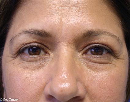 eyelid-surgery-before