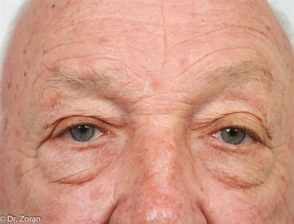 male-before-eyelid-surgery-blepharoplasty