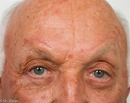 BLEPHAROPLASTY - EYELID SURGERY CASE 78