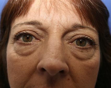 Eyelid Surgery- Blepharoplasty-before