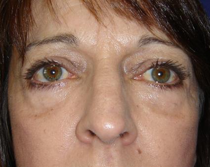 BLEPHAROPLASTY - EYELID SURGERY CASE 79