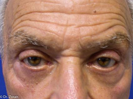 BLEPHAROPLASTY - EYELID SURGERY 80
