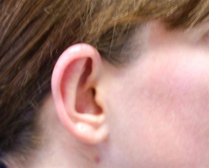 otoplasty-ear-shaping-before