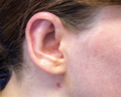 OTOPLASTY - EAR SHAPING 82