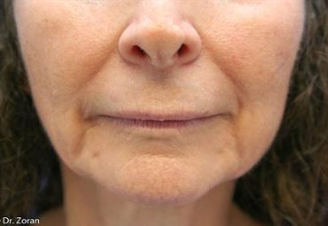 before-lip-enhancement