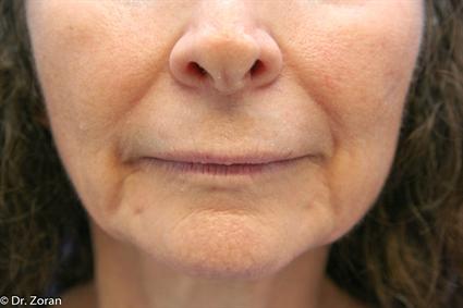 before-lip-enhancement