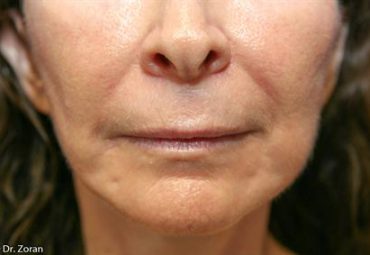 LIP ENHANCEMENT 84