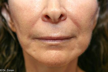 LIP ENHANCEMENT 84