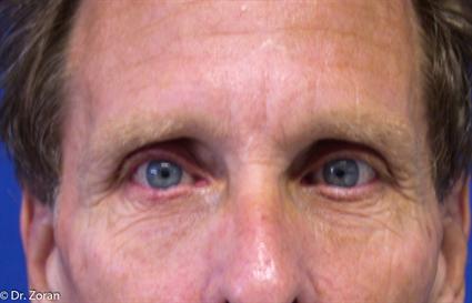 before-brow-lift