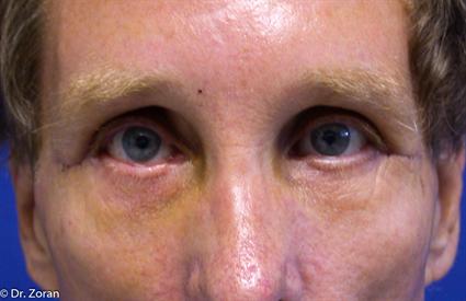 BROW LIFT CASE 86