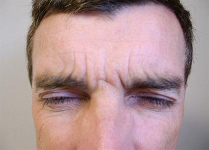 male-before-brow-lift