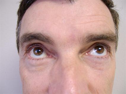 BROW LIFT CASE 87