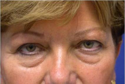 before- UPPER & LOWER EYELID SURGERY
