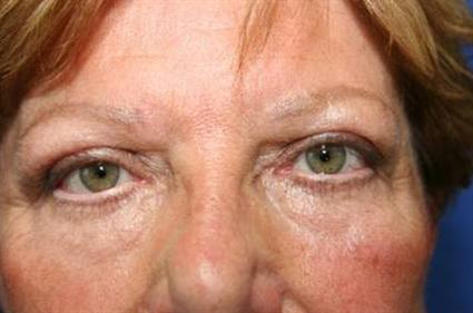BLEPHAROPLASTY - UPPER & LOWER EYELID SURGERY 89