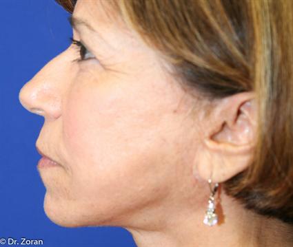 FACIAL FAT GRAFTS 96