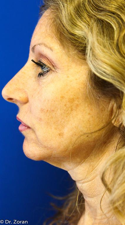 face-lift-and-neck-lift
