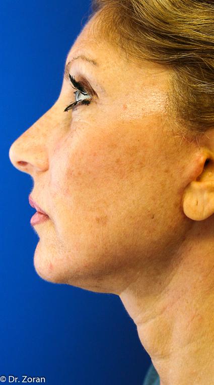 FACE LIFT AND NECK LIFT 97