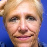 OTOPLASTY - EAR SHAPING 81