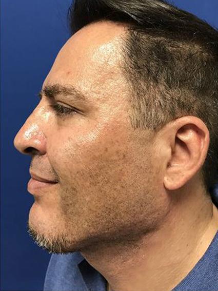 NECK LIFT AND CHIN IMPLANT 373