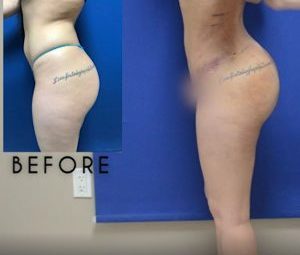 Plastic Surgery Diary: Fat Transfer to Buttock