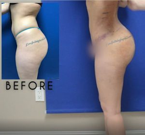 Plastic Surgery Diary: Fat Transfer to Buttock