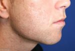 JAW IMPLANT CASE #22