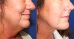 How Much Does a Neck Lift Cost in Fort Lauderdale?